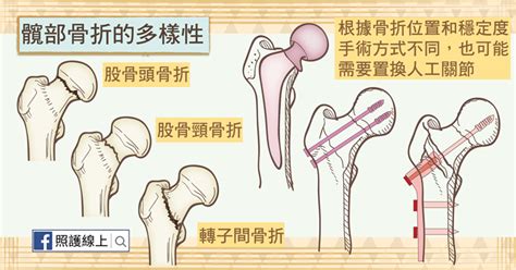 骨質疏鬆帶來的骨折（懶人包） Cpmah 新竹市企業經理協進會 專業創新誠信服務