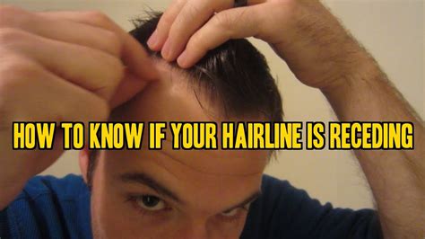 How To Know If Your Hairline Is Receding Youtube