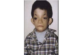 15 Tragic Facial Deformities - Gallery | eBaum's World