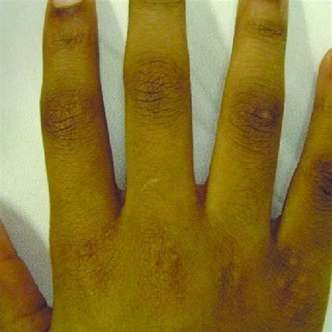 2 Note The Flat Topped Papules On The Third To Fifth Metacarpal Download Scientific Diagram