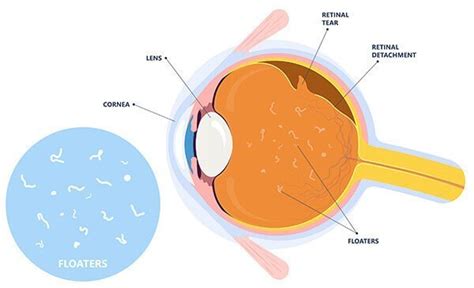 Eye Floaters Treatment in Ayurveda: Holistic Approach & Relief