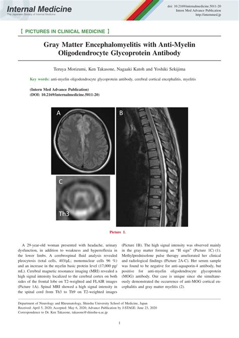 Pdf Gray Matter Encephalomyelitis With Anti Myelin Oligodendrocyte