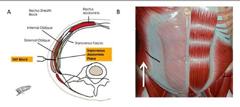 Figure 1 From Use Of Transversus Abdominis Plane Block In Cosmetic