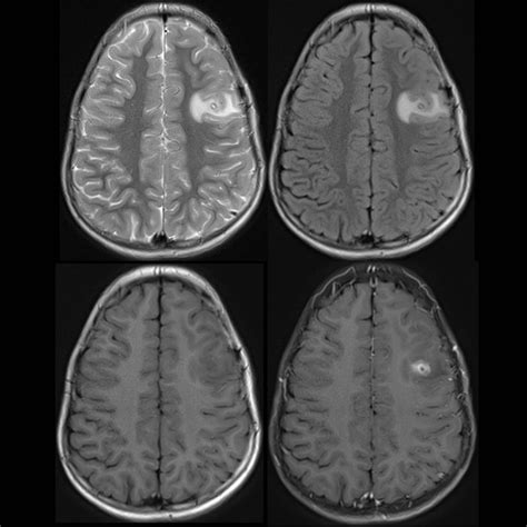 Pediatric Cysticercosis Pediatric Radiology Reference Article