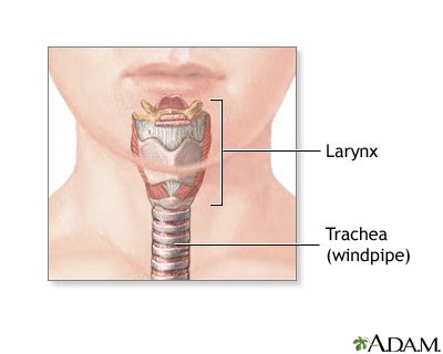 Tracheostomy UF Health