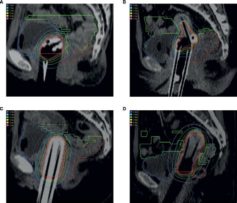 Frontiers An Inverse Dose Optimization Algorithm For Three