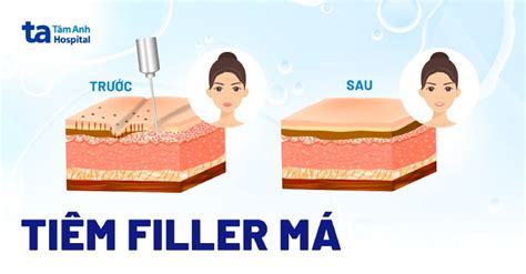 Tiêm filler má là gì Có nên tiêm không Ưu và nhược điểm