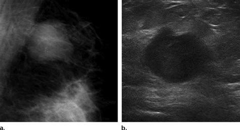 Medullary Carcinoma In A 28 Year Old Woman A Mediolateral Oblique