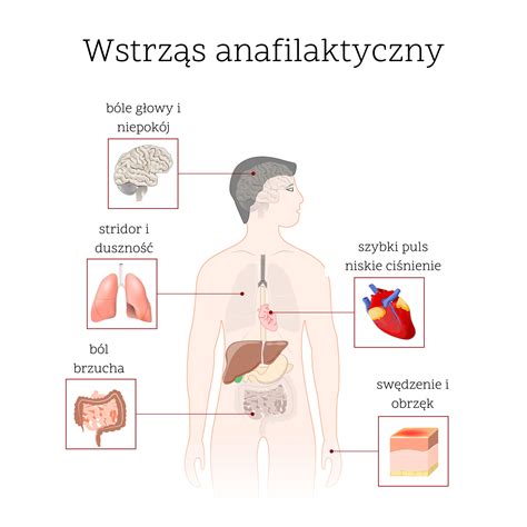 Wstrząs anafilaktyczny Objawy i sposób postępowania przy anafilaksji