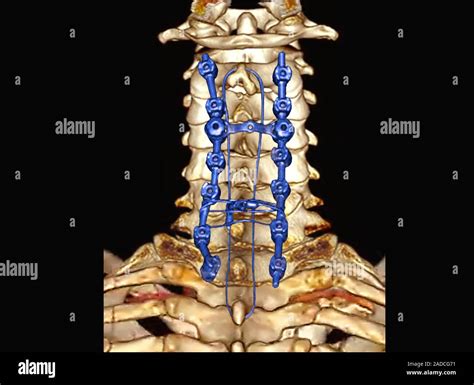 Pinned Neck Vertebrae Coloured D Computed Tomography Ct Scan Of The