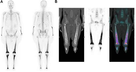 Full Body Bone Scintigraphy And Single Photon Emission Computed