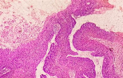 Premium Photo Photomicrograph Showing Tongue Squamous Cell Carcinoma