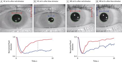 Retinal Architecture And Melanopsin Mediated Pupillary Response