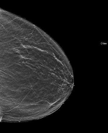 Mammogram - BI RADS 2 | Radiology Case | Radiopaedia.org