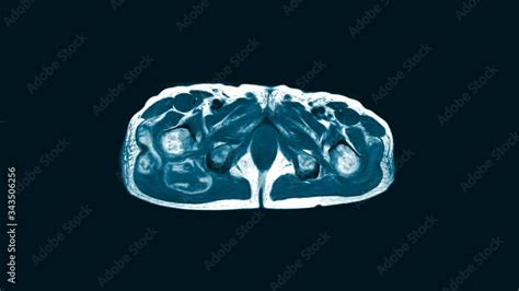 Video „magnetic Resonance Imaging Mri Of Both Hip Sagittal Plane