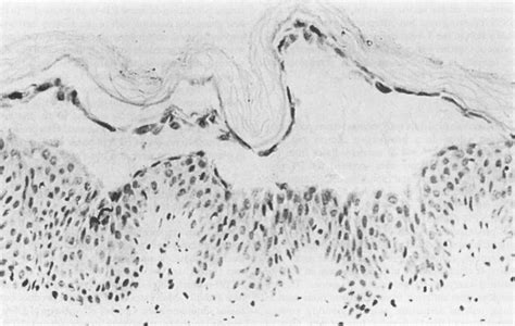 Figure 1 From Staphylococcal Scalded Skin Syndrome Semantic Scholar