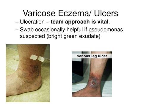 PPT - Varicose Eczema/ Ulcers PowerPoint Presentation - ID:147725