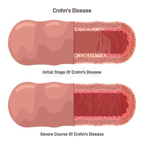 Cobblestone Syndrome Stock Illustrations – 2 Cobblestone Syndrome Stock ...