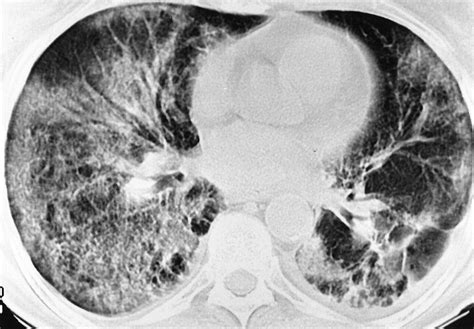 Pulmonary Drug Toxicity Radiologic And Pathologic Manifestations