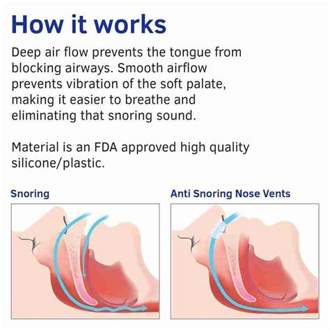 What is snore vent, Do nose vents work for snoring?