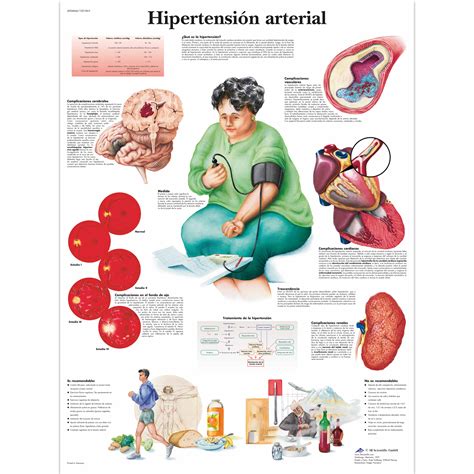 Hipertensión arterial Lámina Anatomical 3D