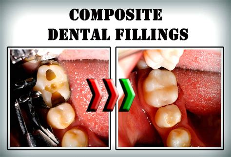 Composite Dental Fillings American Cosmetic Dentistry