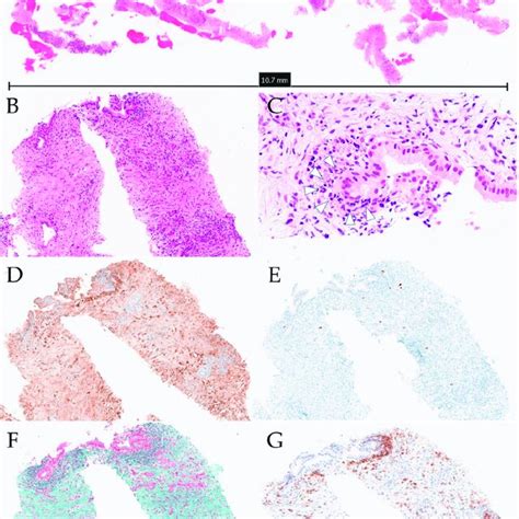 Histopathological Tissue From Case Obtained Using Eus Fnb A Loupe