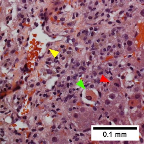 Congestive Hepatopathy Libre Pathology