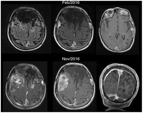 Complications Of Radiotherapy And Radiosurgery In The Brain And Spine