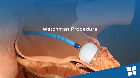 Watchman Procedure Youtube