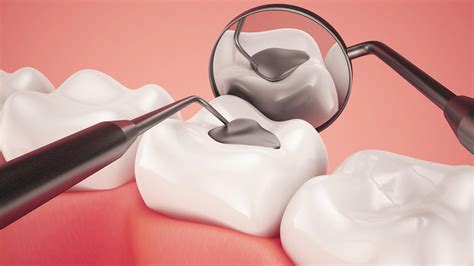 amalgam - Bel Canto Dental