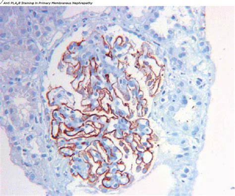 Renal Pathology And Electron Microscopy Dr Lal Pathlabs Blog