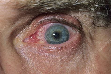 Fungal Corneal Infection