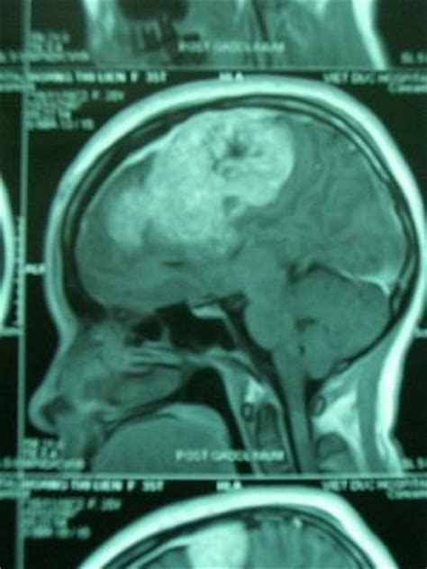 Surgery for meningioma | General center | SteadyHealth.com