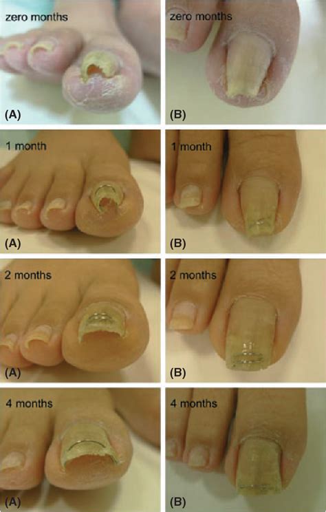 What Is Pincer Nail Commonly Referred To As