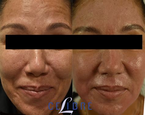 Laser Skin Resurfacing Pores