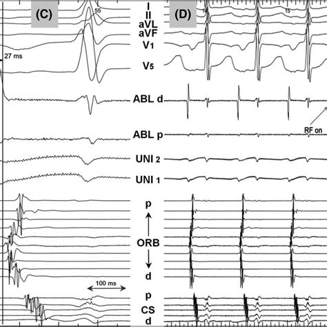 Focal Atrial Tachycardia Termination During Radiofrequency Ablation At Download Scientific