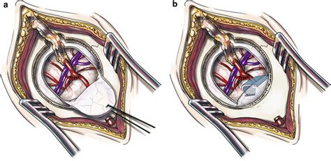 Illustration Of The Mis Eds Technique For Combined Revascularization