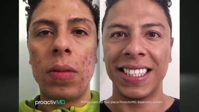 Proactiv Before and After Stories + Pictures and Video