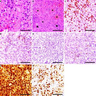 Histological Examination Of The Lesion A H E Staining Showed Mixed