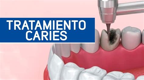 Tratamiento Caries Dental Odontoespecialistas Youtube