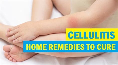 Try 25 Natural Remedies For Cellulitis Treatment At Home And Effective Relief Tips And Beauty