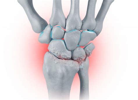 Illustration Wrist Osteoarthritis Medicalgraphics