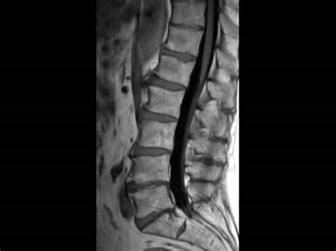 Comprehensive Lumbar Spine Imaging At 3 0t Philips Mr Body Map