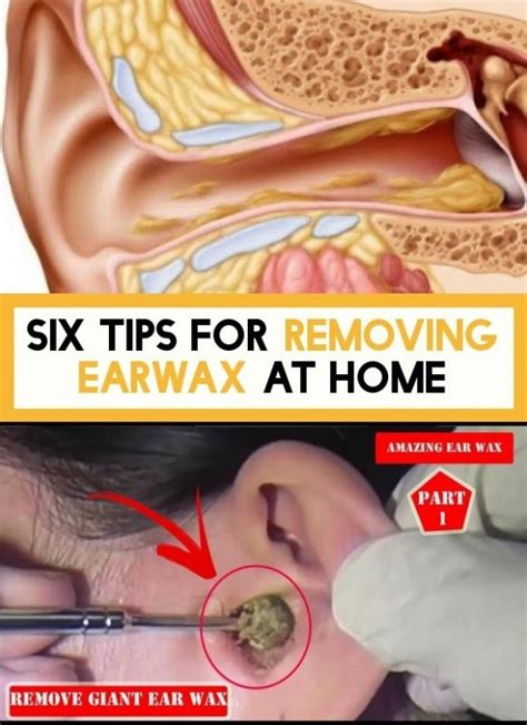 How To Remove Soft Sticky Ear Wax At Vicki Carbone Blog