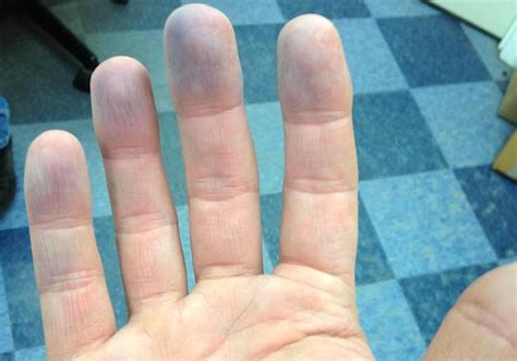 Peripheral Cyanosis Symptoms Causes Diagnosis And Treatment