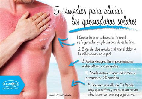 5 remedios para las quemaduras solares Infografías y Remedios