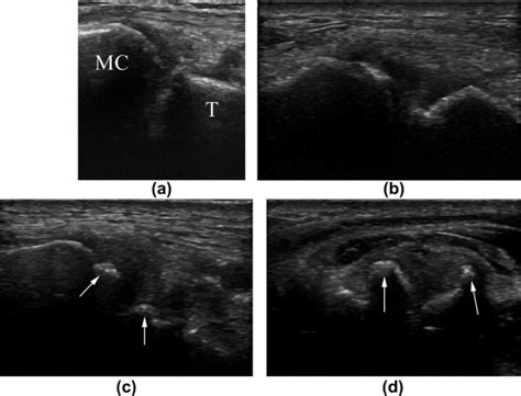 Osteoarthritis Of The Thumb Carpometacarpal Joint Correlation Of