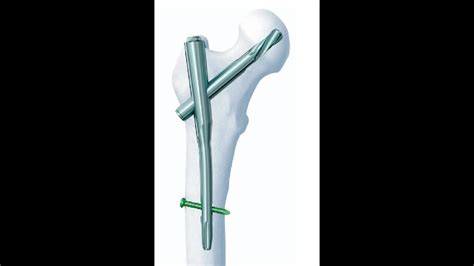 Proksimal Femur Ivisi Proximal Femoral Nail Youtube