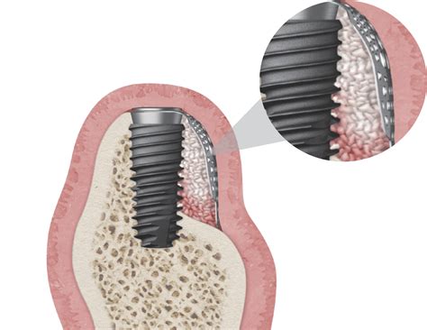 OssBuilder Kit Hiossen Implant